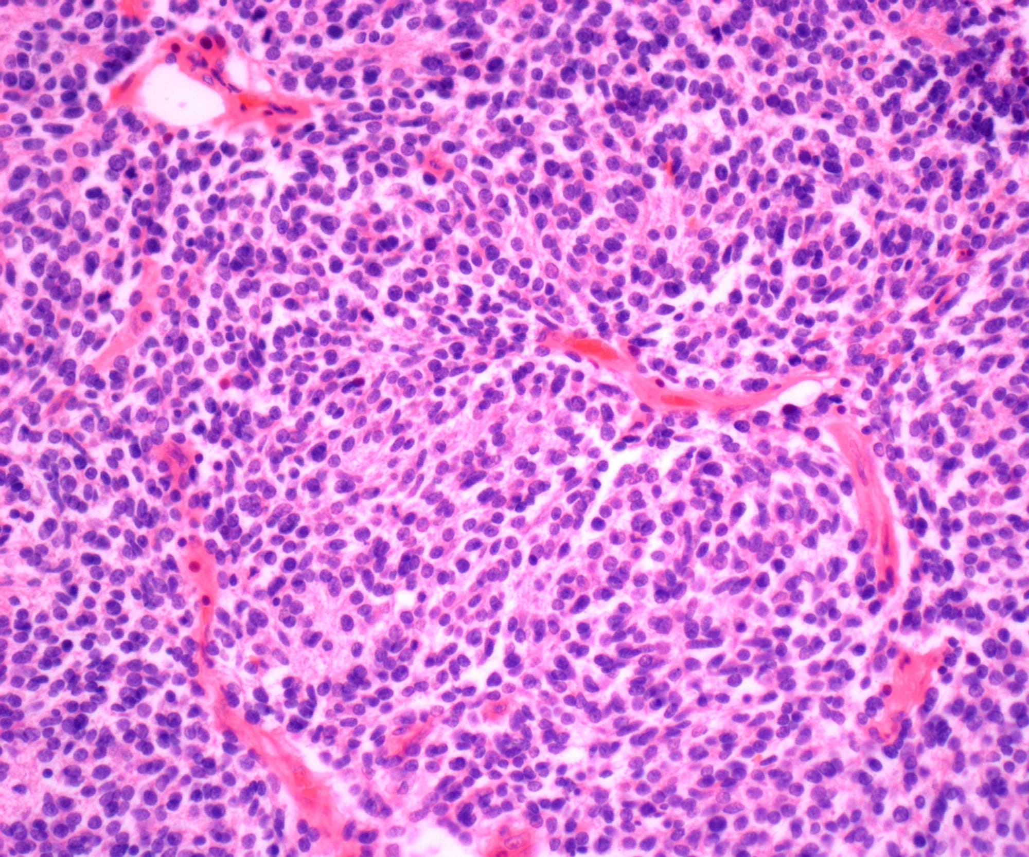 Καρκίνος του ήπατος