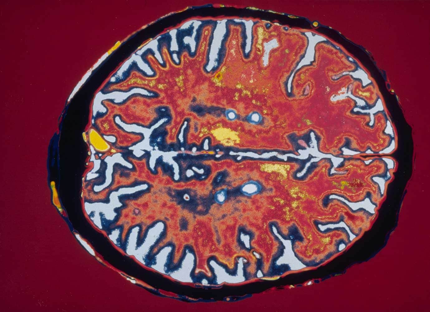 Σκλήρυνση κατά πλάκας